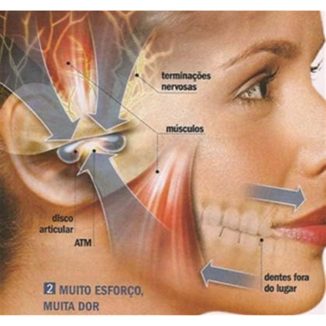 Moldura Multifuncional - Anti Bruxismo