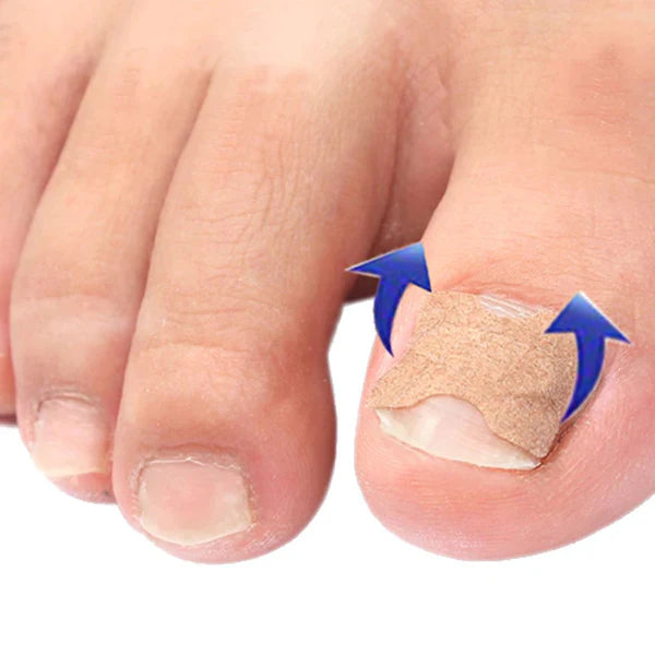 Kit com 100 Adesivos para Unha Encravada - Alivax