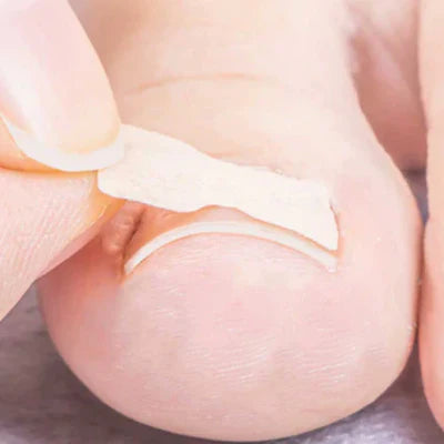 Kit com 100 Adesivos para Unha Encravada - Alivax